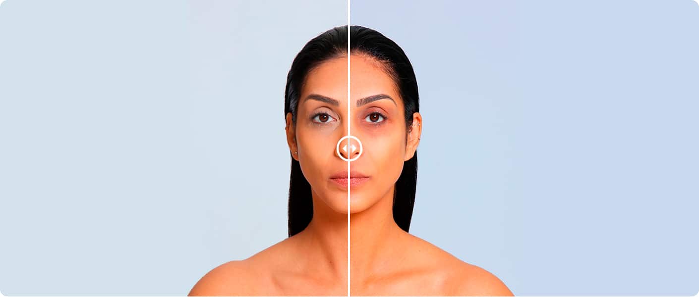 Comparativo antes e depois do tratamento New Eyes na região dos olhos
